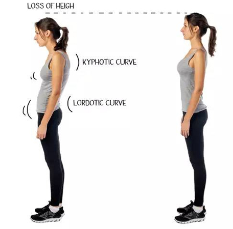 Having a kyphotic curve and/or a lordotic curve results in a loss of height